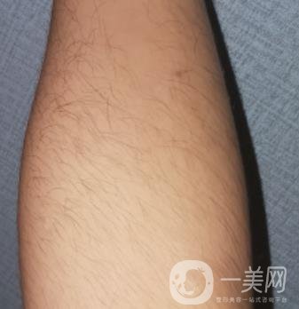 哈醫(yī)大四院整形美容科價(jià)格表鉅惠來(lái)襲，附冰點(diǎn)脫毛案例