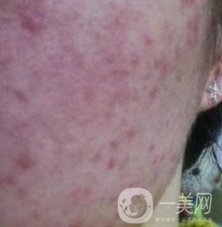 成都軍區(qū)總醫(yī)院整形美容科價格表及祛痘印真人日記