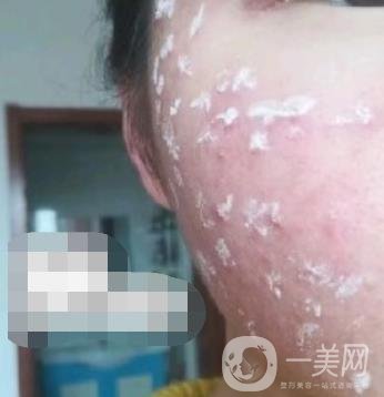 成都軍區(qū)總醫(yī)院整形美容科價格表及祛痘印真人日記