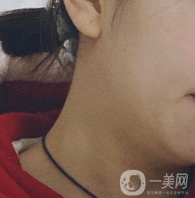 河南省人民醫(yī)院整形美容科價(jià)格表公布，附除腋臭案例