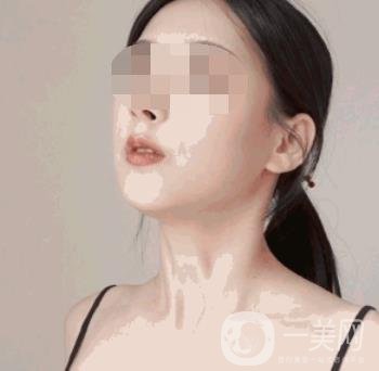 河南省人民醫(yī)院整形美容科價(jià)格表公布，附除腋臭案例