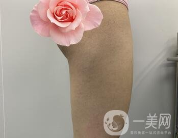 邢臺人民醫(yī)院整形美容科價格表，附大腿吸脂案例