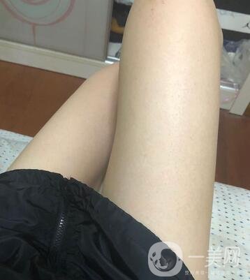 邢臺人民醫(yī)院整形美容科價格表，附大腿吸脂案例