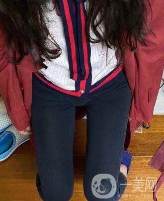 邢臺人民醫(yī)院整形美容科價格表，附大腿吸脂案例