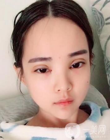 湖南第一醫(yī)院整形科價(jià)格表，附雙眼皮案例