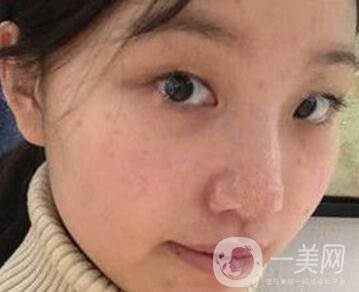 青島青醫(yī)附院整形價格表，還有雙眼皮實例