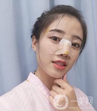 哈爾濱醫(yī)大二院美容科隆鼻*果咋樣?附價(jià)格表一覽