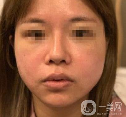 常州第一人民醫(yī)院*案例*果及整形價格表分享