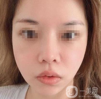 常州第一人民醫(yī)院*案例*果及整形價格表分享