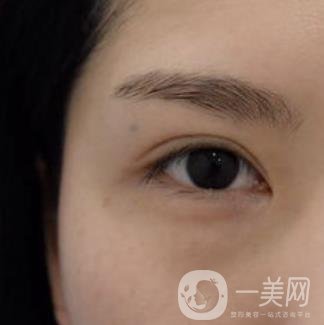 廣州人民醫(yī)院整形價格表，附去眼袋案例
