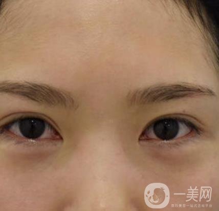 廣州人民醫(yī)院整形價格表，附去眼袋案例