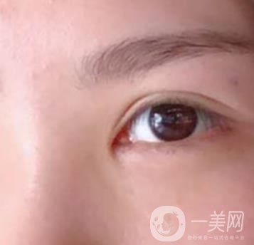 廣州人民醫(yī)院整形價格表，附去眼袋案例