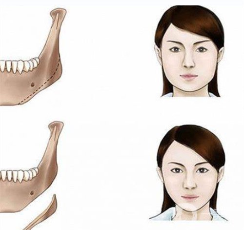 天津做改臉型術(shù)要多少錢