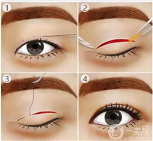 天津璦珊整形醫(yī)院雙眼皮整形日記_價(jià)格表介紹一覽