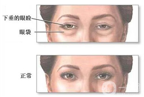 天津醫(yī)科大學(xué)眼科醫(yī)院做眼袋*果如何?價(jià)格價(jià)目表2020年全新公布