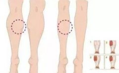 小腿抽脂后凹凸不平怎么辦？