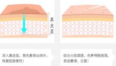 像素激光和點(diǎn)陣激光的不同之處是什么？