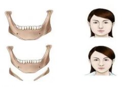 下頜角整形是削骨嗎，下頜角整形意味著什么？