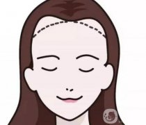 脫發(fā)際線產(chǎn)生的副作用如何避免？
