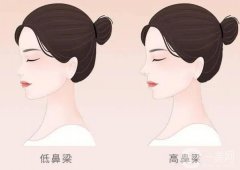 假體隆鼻對人體有害嗎?隆鼻后假體變化大嗎?