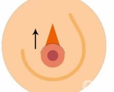 乳暈手術(shù)的特點(diǎn)是什么?需要注意哪些事項(xiàng)？