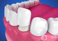 做了烤瓷牙可以做核磁共振嗎？