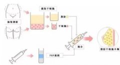 自體脂肪和脂肪膠的區(qū)別是什么？
