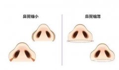 怎么避免鼻翼縮小的后遺癥？