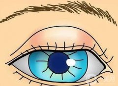 眼皮抽脂后怎么護(hù)理？