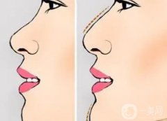 隆鼻可以用自體脂肪嗎?