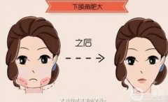 適合磨骨瘦臉的人群有哪些？