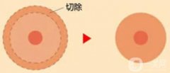 乳暈縮小手術(shù)對身體影響大不大？