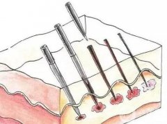 哪些因素影響微針恢復(fù)的時(shí)間?