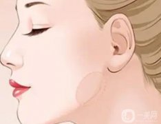 下頜角整容疼嗎？果好嗎？