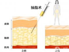 能在抽脂之后立即走路嗎？