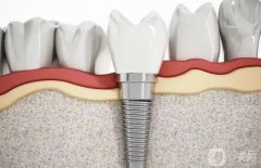 做種植牙后可以做核磁共振嗎？