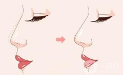 駝峰鼻要不要磨骨？怎么矯正？