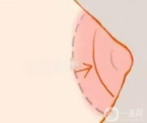 乳暈縮小術(shù)有幾種方法？
