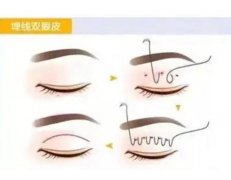 納米雙眼皮與埋線是一樣嗎？