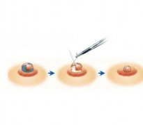 做乳暈縮小術(shù)有什么風(fēng)險？不適合哪些人？