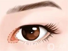 開眼角是否會導(dǎo)致疤痕？開眼角有哪些危害？