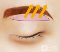提眉術(shù)與切眉術(shù)的區(qū)別是什么?