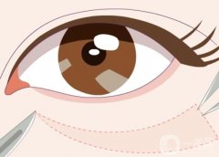 超聲波去眼袋有嗎？超聲波去眼袋有什么副作用？