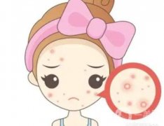 激光祛痘步驟,激光痘印的風險有多大？