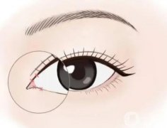 開眼角之后抽煙有哪些危害呢？