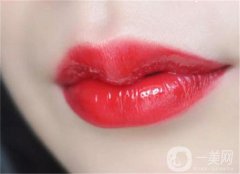 微笑唇部手術(shù)后需要幾天拆線？