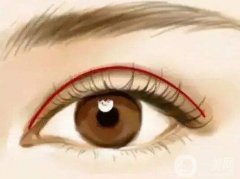 不同的割雙眼皮方式有什么優(yōu)缺點(diǎn)?