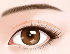 開眼角后的疤痕能否修復(fù)？開眼角疤痕消除需要多久