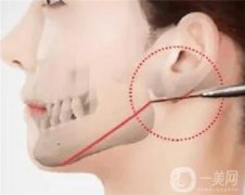 哪些因素影響磨腮削骨的愈合？