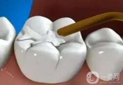 補(bǔ)牙是不是*性的？